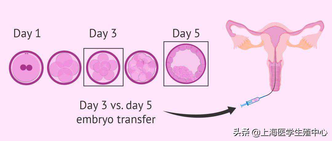 多囊怀孕香港验血,鲜胚移植第8天出血未必是试管失败的症状