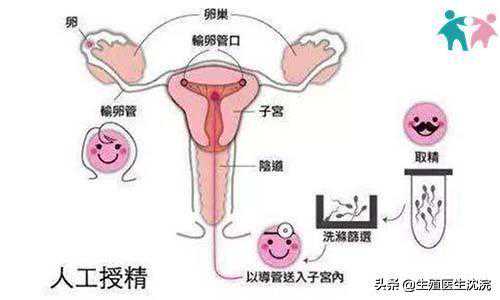 香港验血女孩绝对吗,备孕多年没怀上可以人工授精？关于人工授精你了解多少